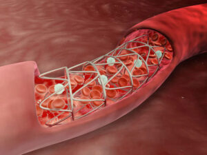 Cardiothoracic supplies and stents